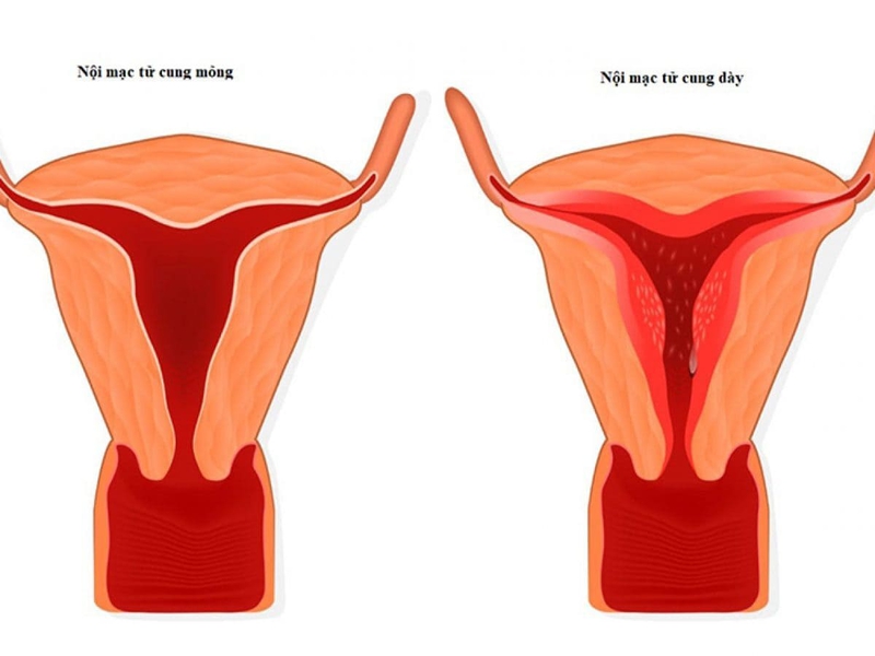 Nội mạc tử cung mỏng: Nỗi lo của mẹ bầu 2
