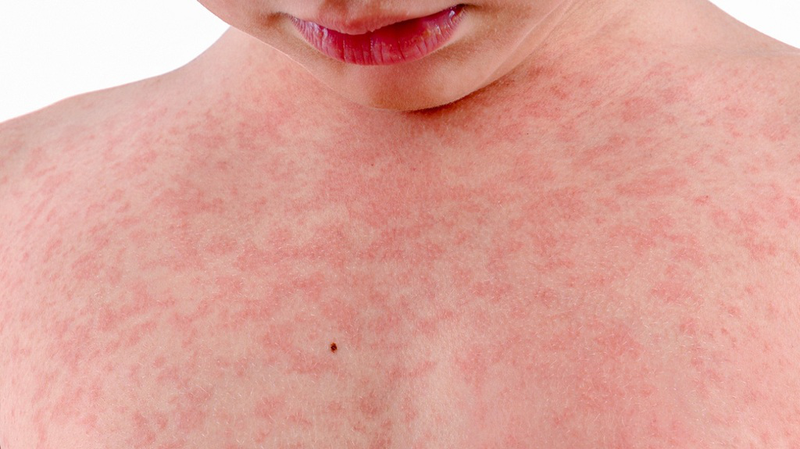 Nổi mẩn đỏ ngứa như muỗi đốt: Nguyên nhân, triệu chứng và cách xử lý 1
