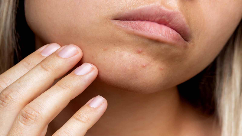 Nổi mụn ở cằm là thiếu chất gì​? Lưu ý khi điều trị mụn ở cằm 1