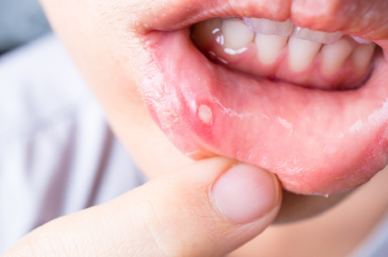 Nổi mụn trắng trong miệng không đau là dấu hiệu bệnh gì 1