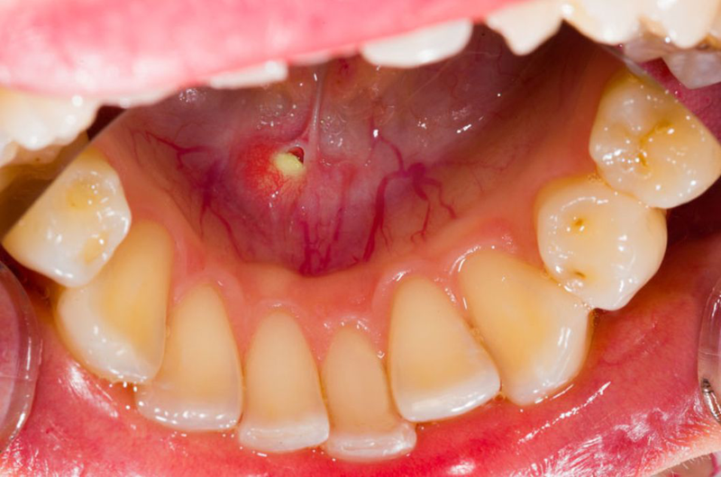 Nổi mụn trắng trong miệng không đau là dấu hiệu bệnh gì 3