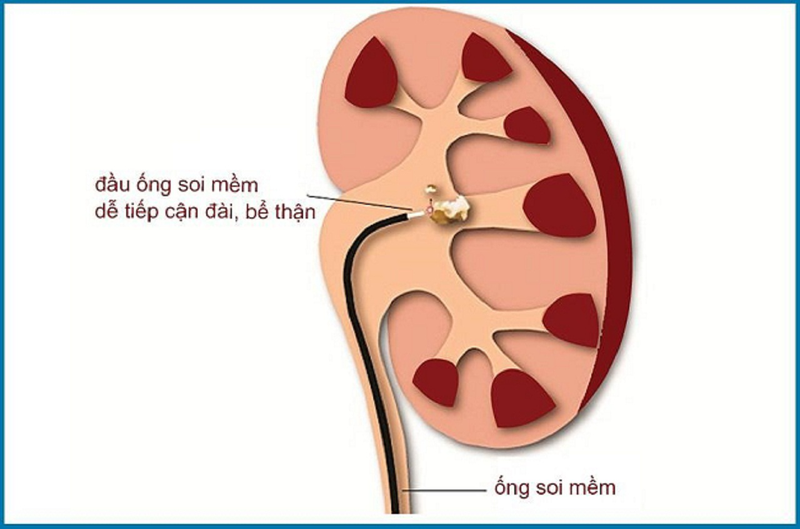 Nội soi tán sỏi ngược dòng bằng ống mềm 3