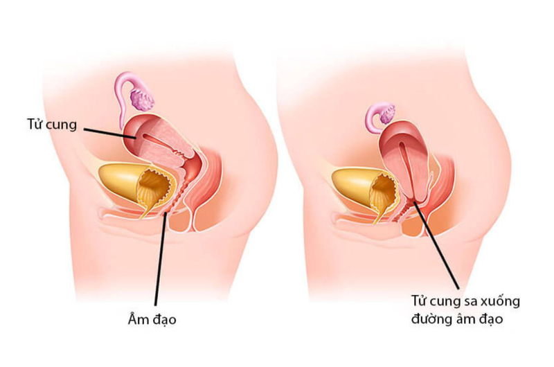 Tử cung treo là gì? Những điều cần biết về phương pháp điều trị