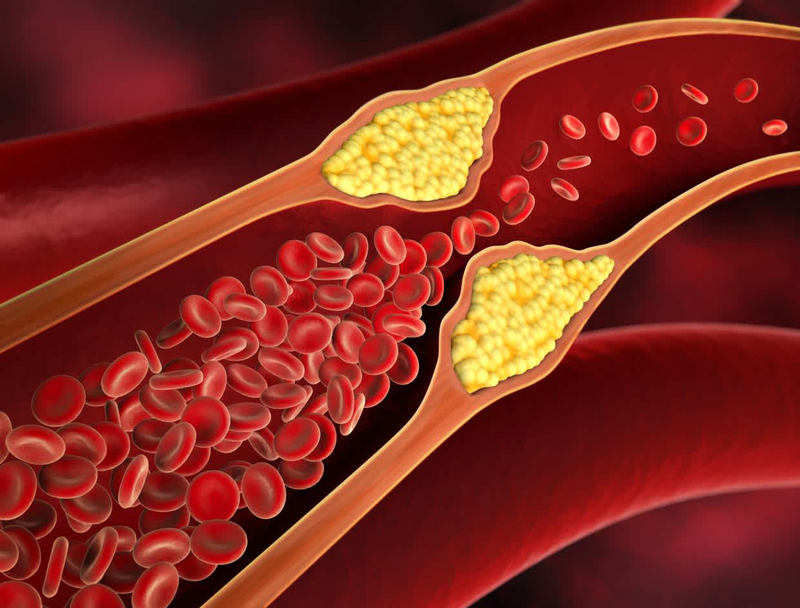 Non HDL cholesterol là gì và tầm quan trọng của nó đối với sức khỏe 1