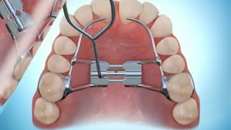 Nong hàm trong niềng răng là gì? Tìm hiểu về kỹ thuật nong hàm 1