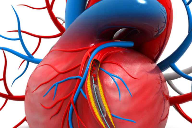 Nong mạch vành và đặt stent: Thủ thuật an toàn và hiệu quả cho người bệnh tim mạch 1