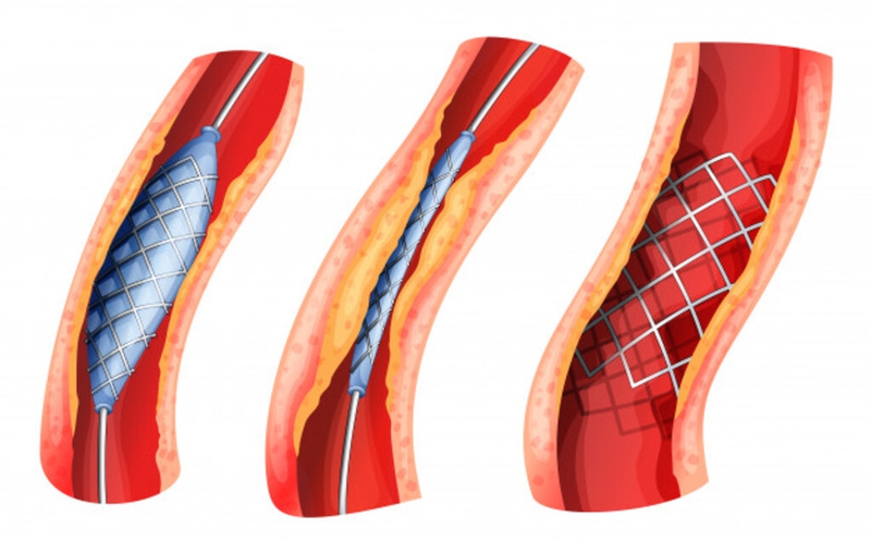 Nong mạch vành và đặt stent: Thủ thuật an toàn và hiệu quả cho người bệnh tim mạch 2