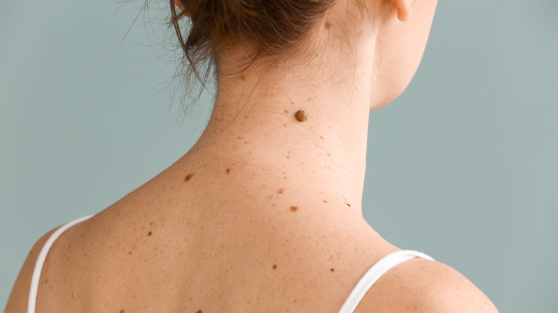 Nốt ruồi son ở cổ phụ nữ xuất hiện do đâu? 3 cách xóa nốt ruồi son phổ biến 1