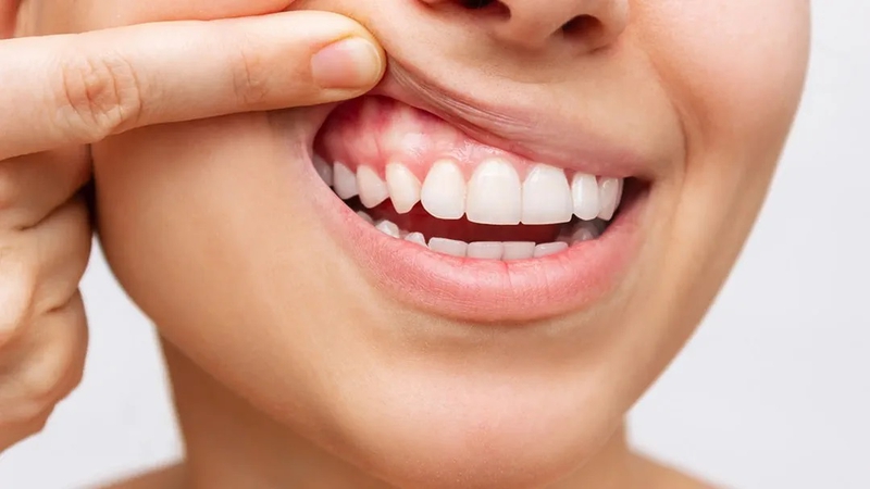 Cấu tạo của nướu răng và các bệnh lý thường gặp ở nướu răng 2