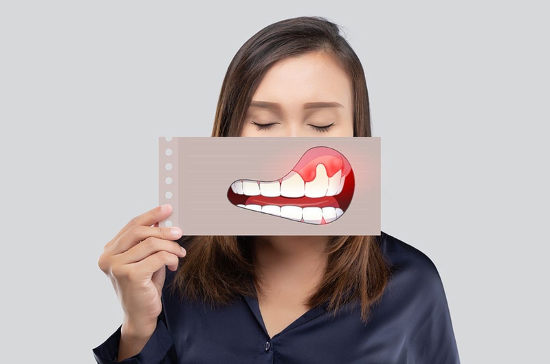 Cấu tạo của nướu răng và các bệnh lý thường gặp ở nướu răng 3