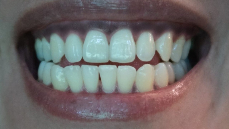 Nướu răng bị đen: Nguyên nhân, triệu chứng, cách điều trị 1