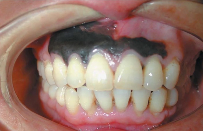 Nướu răng bị đen: Nguyên nhân, triệu chứng, cách điều trị 2