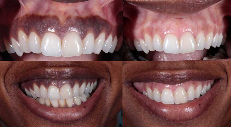 Nướu răng bị đen: Nguyên nhân, triệu chứng, cách điều trị 4