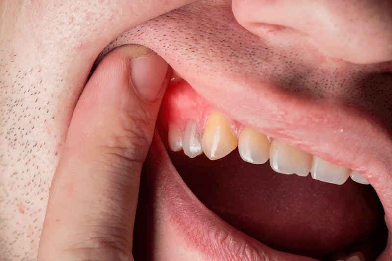 Nướu răng bị đỏ: Nguyên nhân và cách xử trí 1