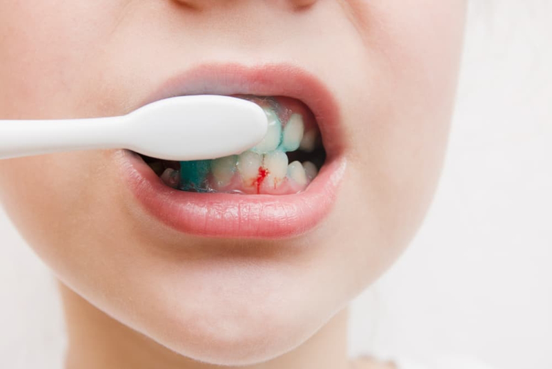 Nướu răng bị đỏ: Nguyên nhân và cách xử trí 4