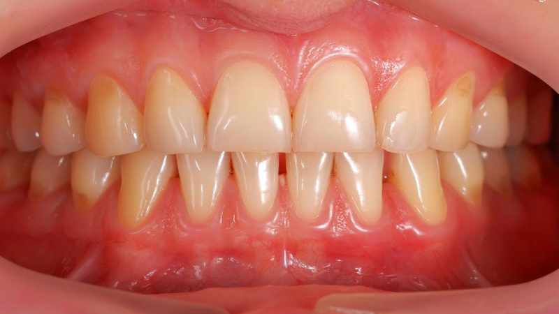 Nướu răng là gì? Cấu tạo, chức năng và các bệnh liên quan 4