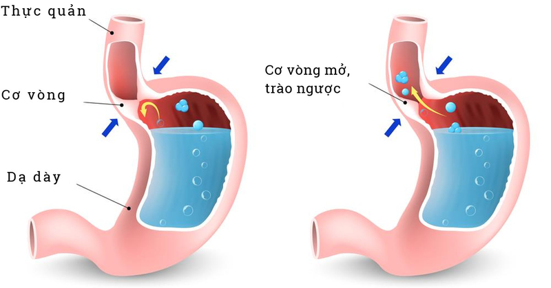 o-chua-buon-non-nguyen-nhan-cach-khac-phuc-3.jpg