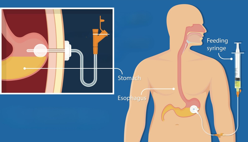 Tìm hiểu chi tiết về thủ thuật đặt ống thông dạ dày 2