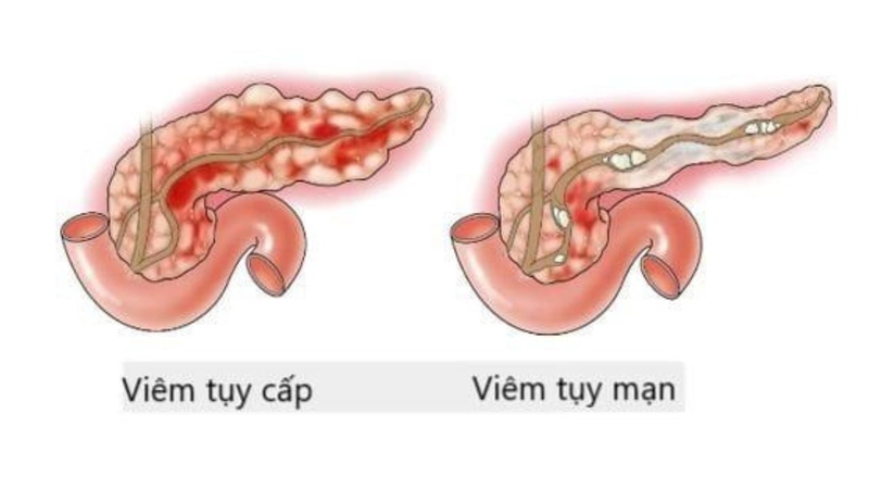 Ống wirsung giữ vai trò gì? Các biến thể giải phẫu của ống wirsung 2