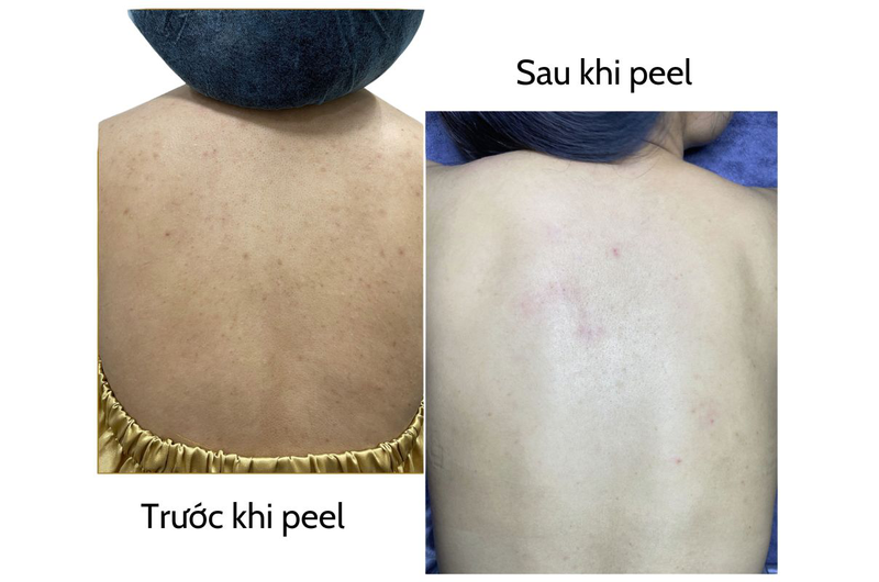 Tìm hiểu về phương pháp, cấp độ và các bước peel da body 3