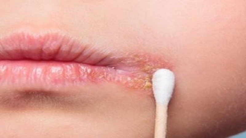 Phác đồ điều trị Herpes môi giúp kiểm soát các triệu chứng 1