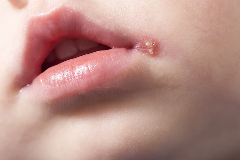 Phác đồ điều trị Herpes môi giúp kiểm soát các triệu chứng 2