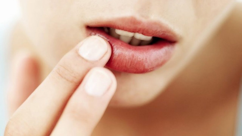Phác đồ điều trị Herpes môi giúp kiểm soát các triệu chứng 3