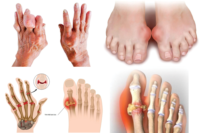 Phân biệt bệnh gout và giả gout 1