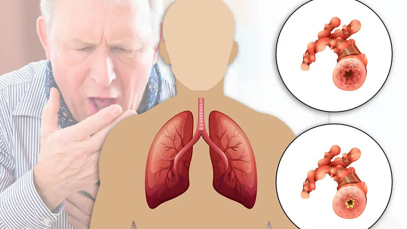 Cách phân biệt hen suyễn và phổi tắc nghẽn mãn tính COPD 2