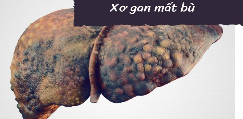 Phân biệt xơ gan còn bù - xơ gan mất bù