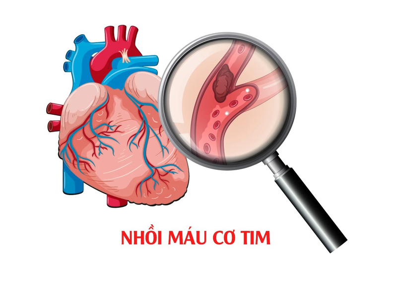 Tìm hiểu về phân độ Killip trong nhồi máu cơ tim cấp 1