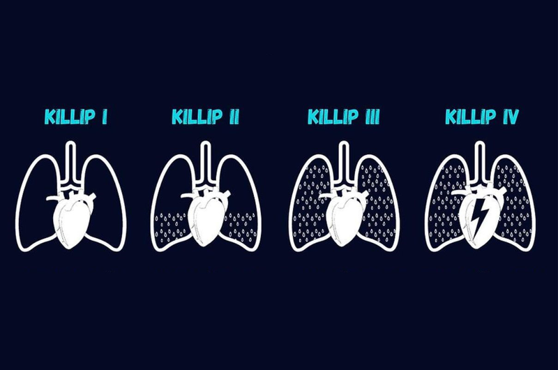 Tìm hiểu về phân độ Killip trong nhồi máu cơ tim cấp 2