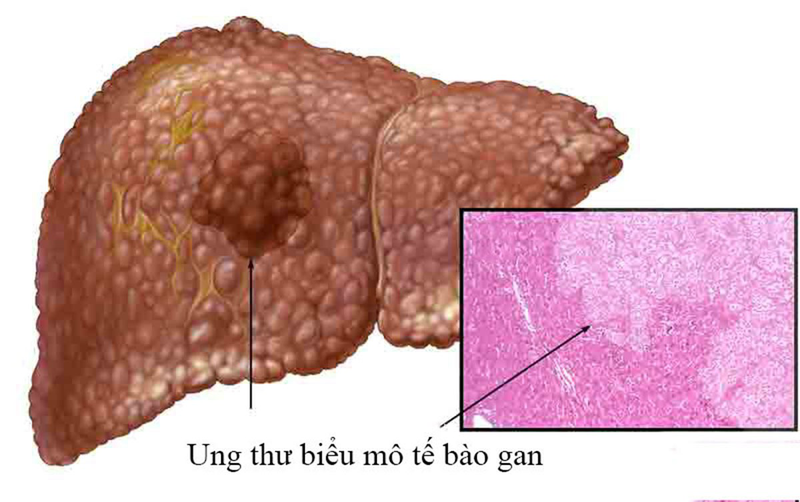 Phân thùy gan theo cách nào và ứng dụng trên lâm sàng? 4