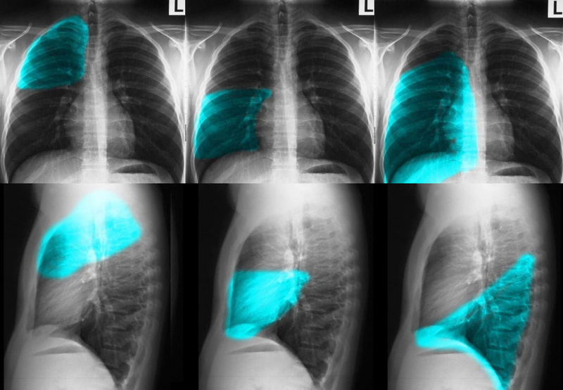 Phân thùy phổi trên phim X-quang: Hướng dẫn chi tiết và khoa học 1