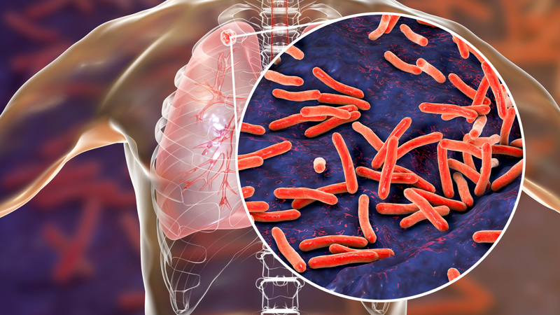 Phản ứng Tuberculin trong chẩn đoán bệnh lao 1