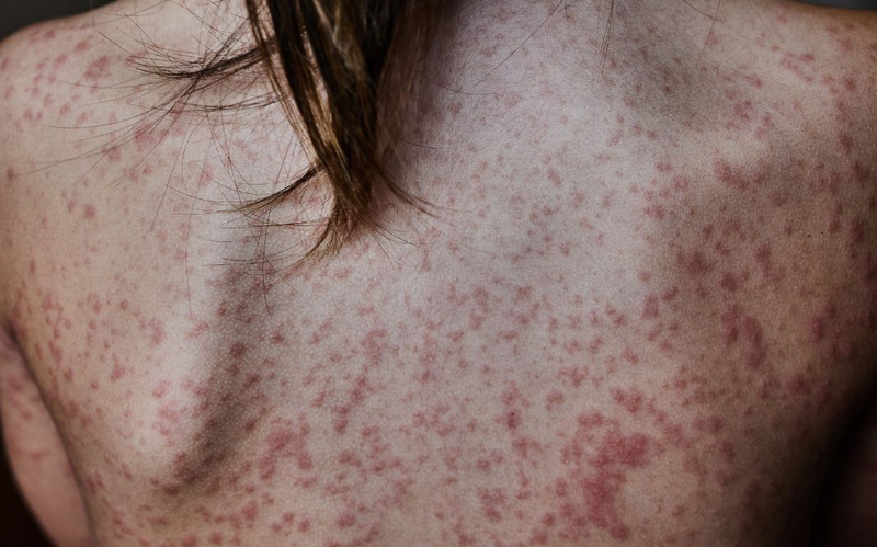 Phát ban sốt xuất huyết có ngứa không? Cách giảm ngứa khi bị sốt xuất huyết 1