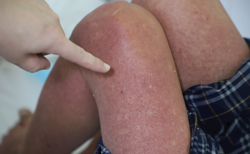 Phát ban sốt xuất huyết có ngứa không? Cách giảm ngứa khi bị sốt xuất huyết 2