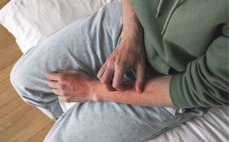 Phát ban sốt xuất huyết có ngứa không? Cách giảm ngứa khi bị sốt xuất huyết 4