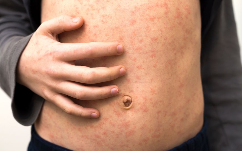 Phát ban sốt xuất huyết có ngứa không? Cách giảm ngứa khi bị sốt xuất huyết 3