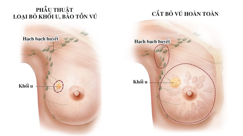 Phẫu thuật cắt bỏ khối u là gì?-1