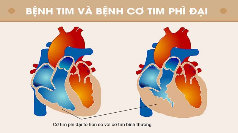 Bệnh cơ tim phì đại làm giảm khả năng bơm máu từ tim đến các cơ quan, gây ra thiếu hụt oxy cho cơ thể