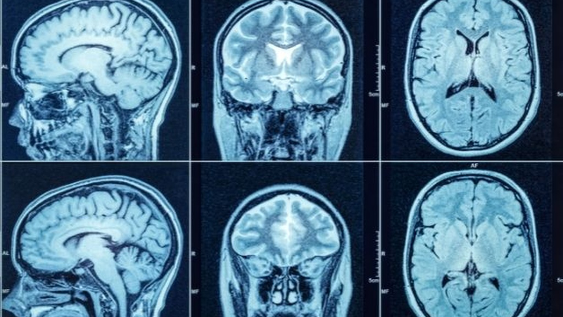 Phẫu thuật sọ não: Hiểu rõ quy trình, rủi ro và biện pháp phòng ngừa biến chứng 2