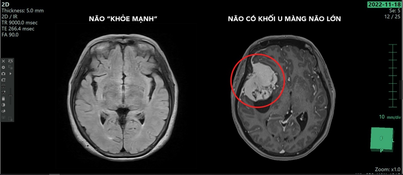 Tìm hiểu về phẫu thuật u màng não lỗ chẩm 1