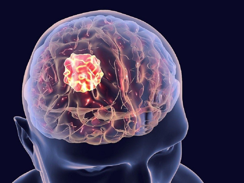 Phẫu thuật u não: Thông tin nên biết về phương pháp điều trị này! 1