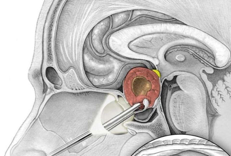 Phẫu thuật u tuyến yên và những điều cần biết 1