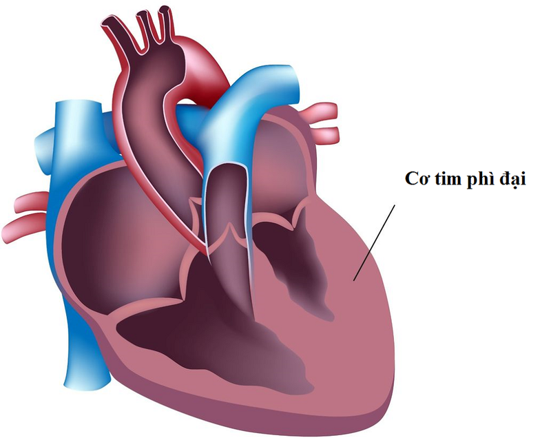 Phì đại tâm thất ở tim là gì? Nguyên nhân và dấu hiệu nhận biết bệnh thế nào? 1