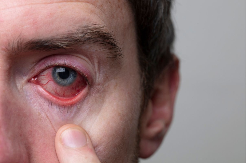 Phòng ngừa đau mắt đỏ hiệu quả với những mẹo sau 1