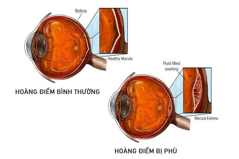 Phù hoàng điểm do tiểu đường: Nguyên nhân, triệu chứng, cách điều trị 1