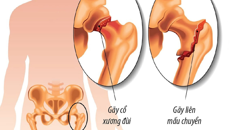 7. Kết luận về phù tủy xương mâm chày