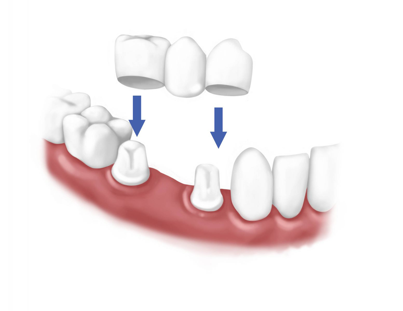 Phục hình răng là gì? Có những phương pháp phục hình răng nào?-1